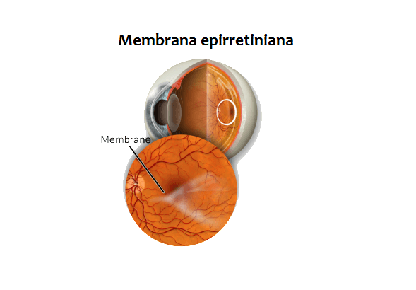 Membrana epirretiniana macular