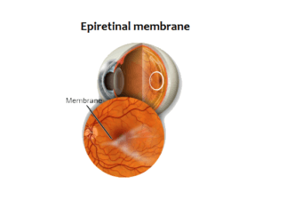 Macular epiretinal membrane