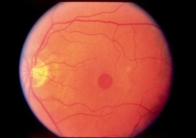 Enfermedades Y Problemas Oculares Institut Catala De Retina