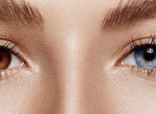 heterocromia o ojos de distinto color