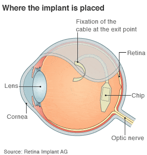 Retina implant