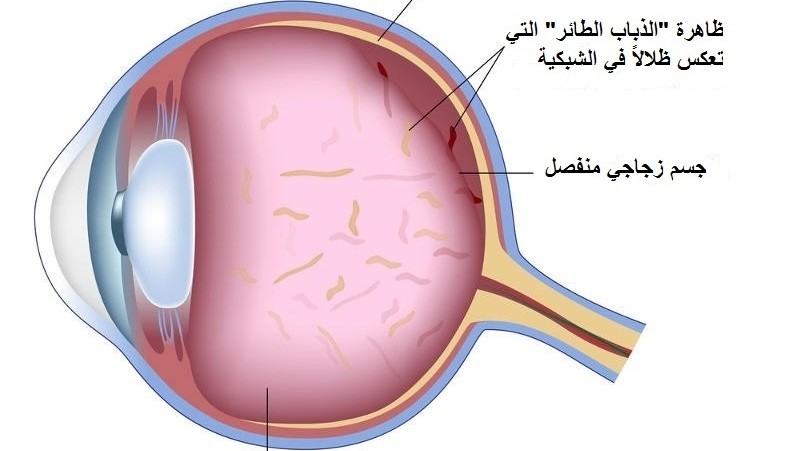 مرض أنفصال الجزء الزجاجي في العين ما هو و ما اهي انواعه Icr