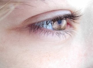 Eyelid and orbital tumors
