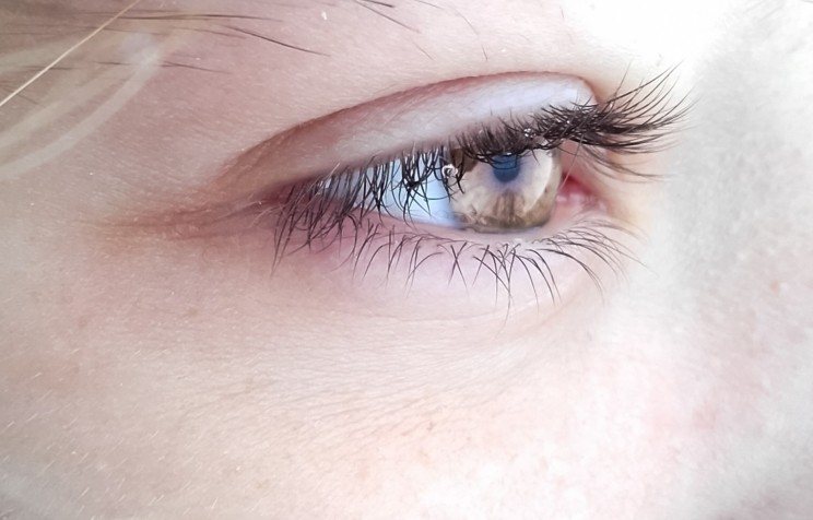 Eyelid and orbital tumors