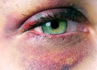 eye injuries