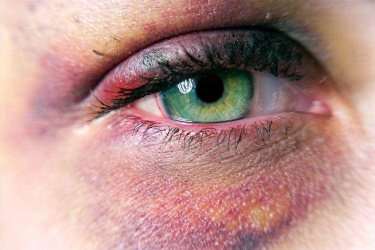 Bruising around eyes on sale without injury