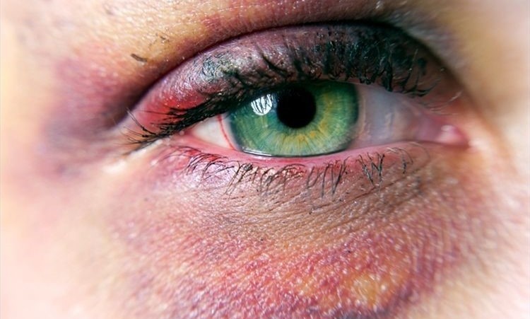 Traumatismos oculares
