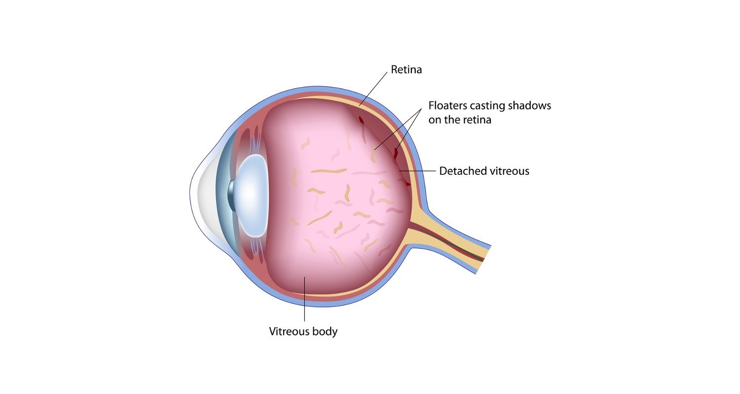 Black Spot in the Eyes - Eye Floaters - Centre For Sight