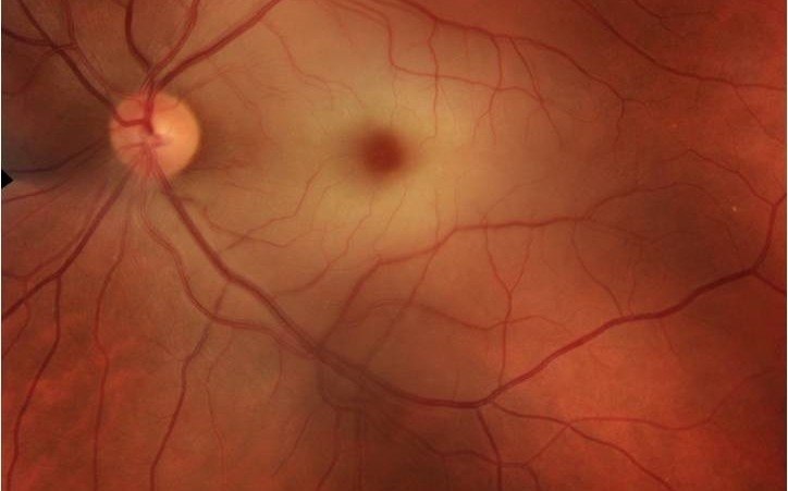 fundoscopia diabetes hipertensión y corazón