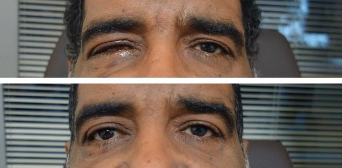 Reconstrucción de cavidades oculares