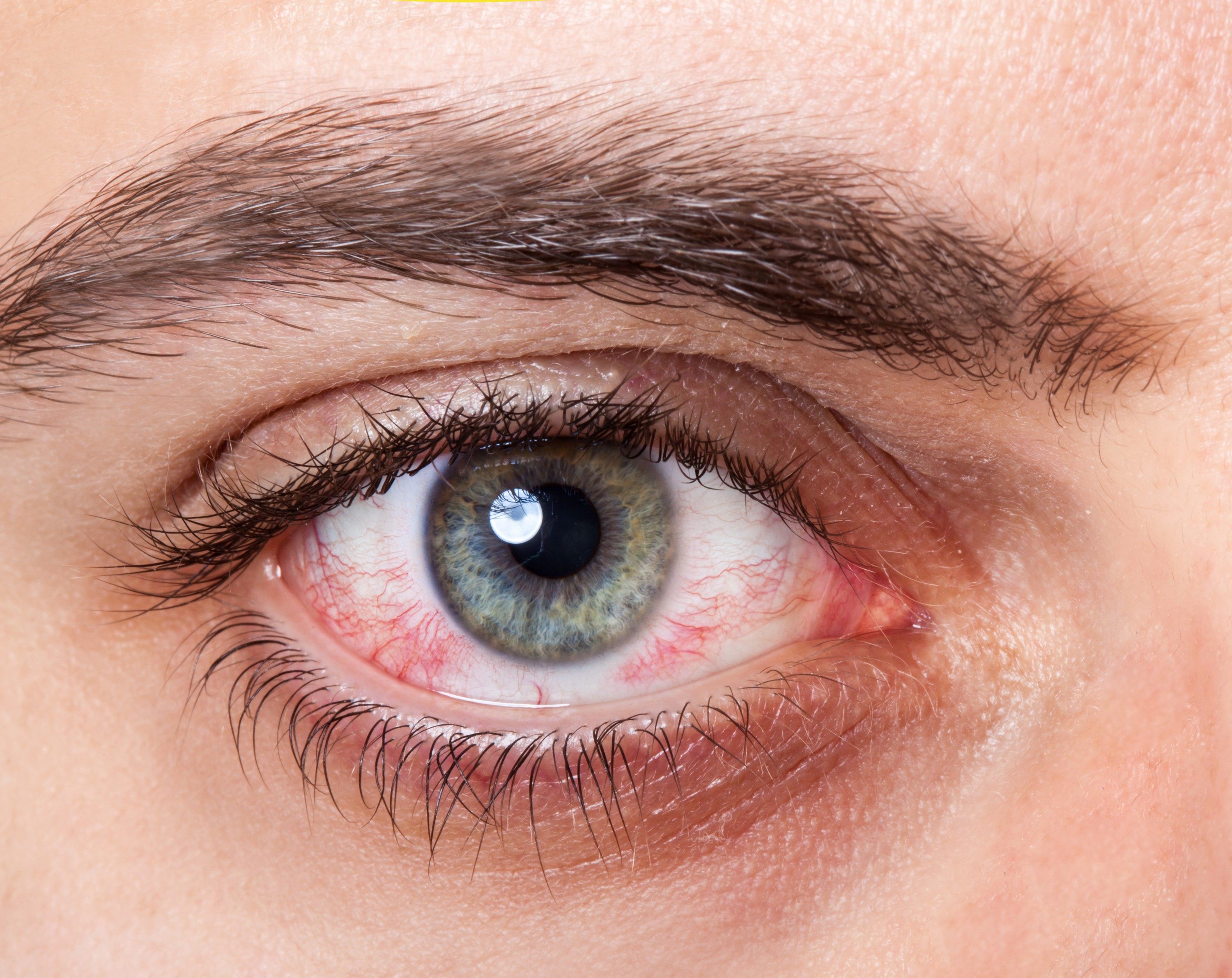 Yeux rouges: que faire?