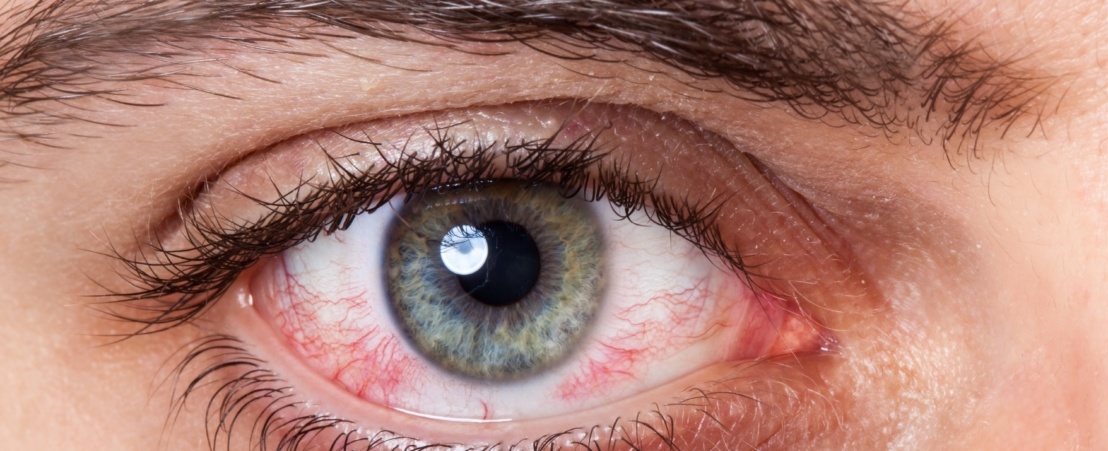 Почему могут болеть глаза и как это исправить
