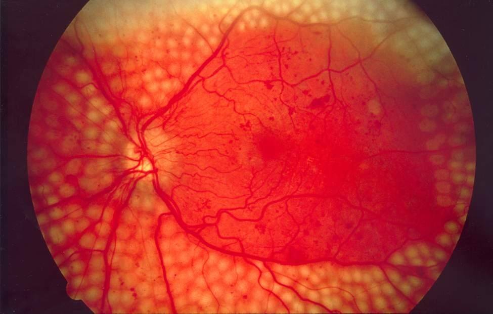 retinopatia diabetica no proliferativa