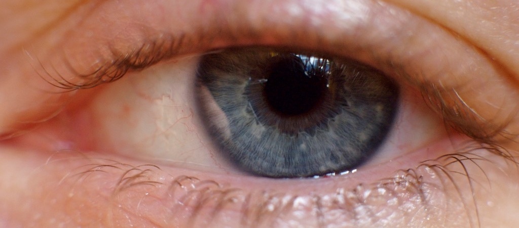 Eye with blepharitis - ICR