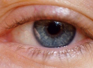 Eye with blepharitis - ICR