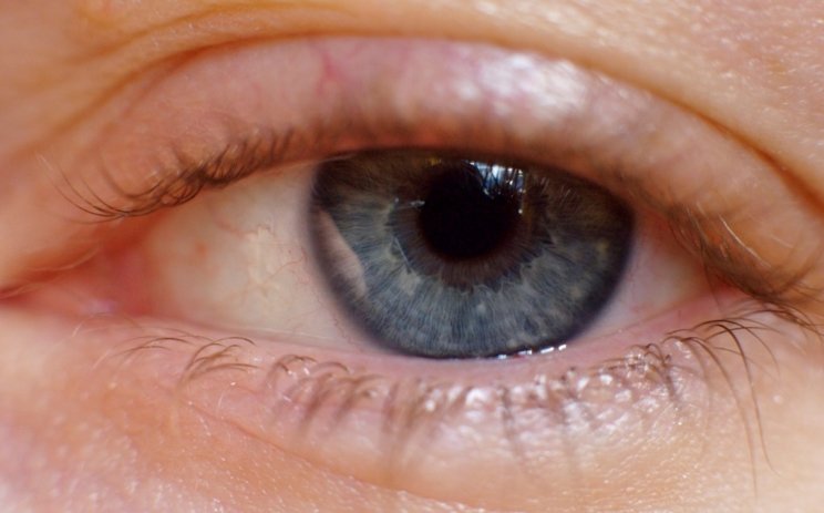 Eye with blepharitis - ICR