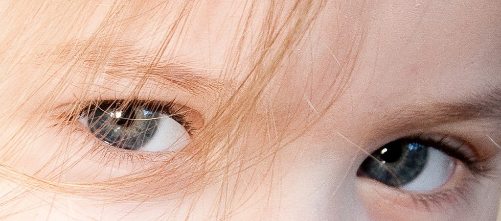 Ювенильная макулярная дистрофия