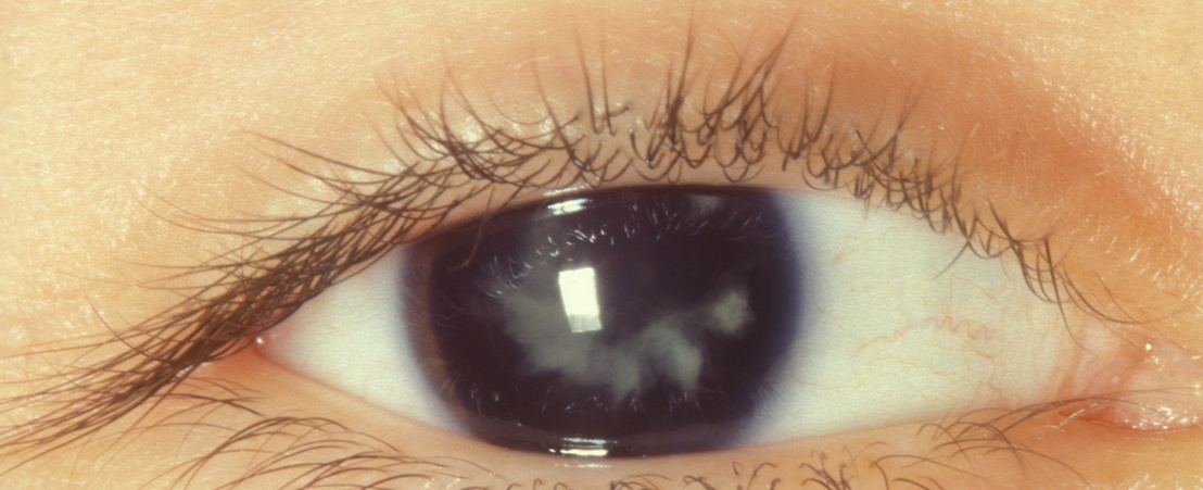 What is secondary cataract?