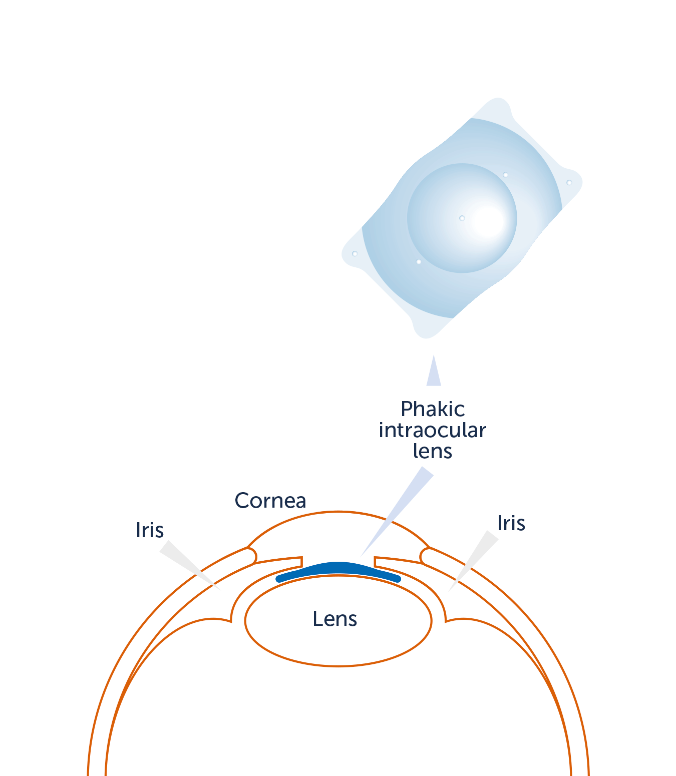 Intraocular lens