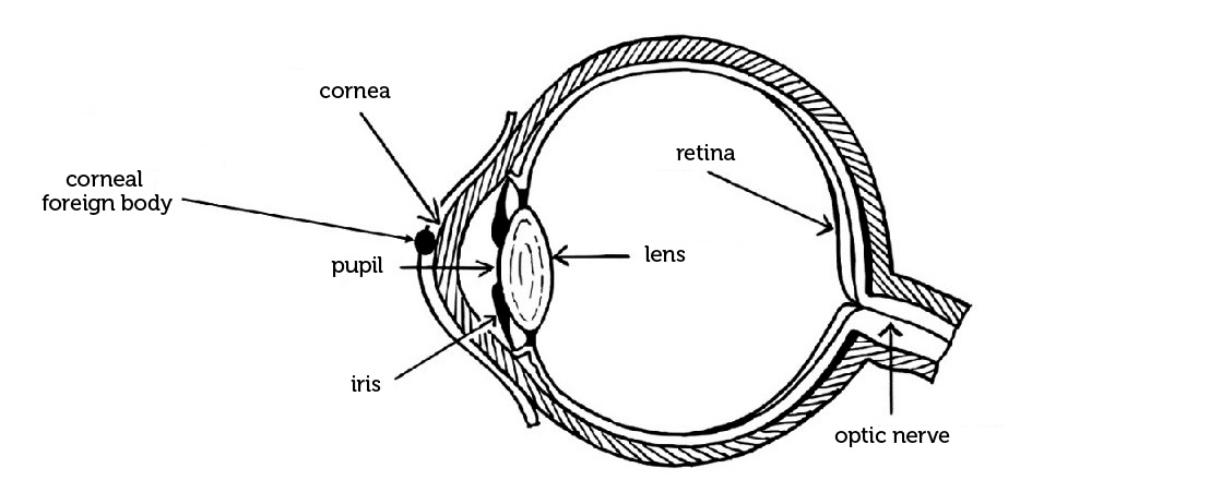 Corneal injuries:  lacerations and abrasions