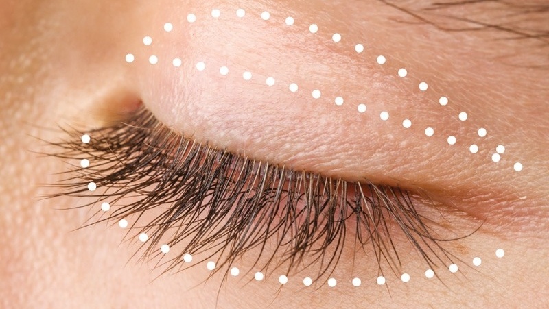  Eyelid surgery or blepharoplasty