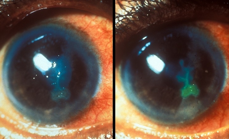 infecciones oculares crónicas por contacto