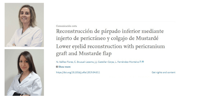 El Dpto. de Oculoplastia publica un artículo sobre un caso de reconstrucción de párpado inferior