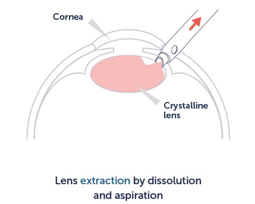 Lens extraction by dissolution and aspiration