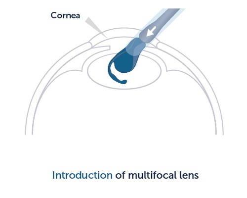 Introduction of multifocal lens