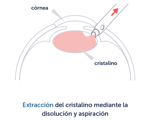 Extracción del cristalino mediante la disolución y aspiración