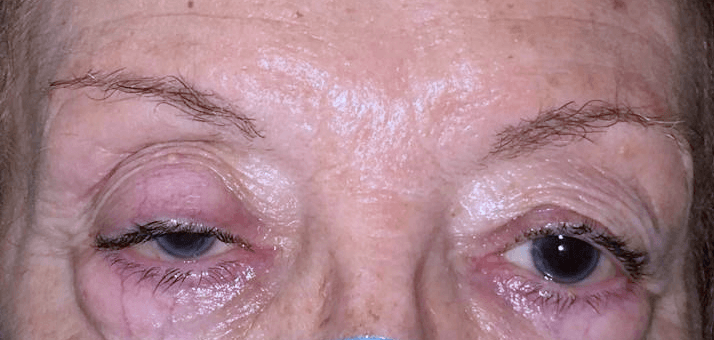 Palpebral ptosis or drooping eyelid