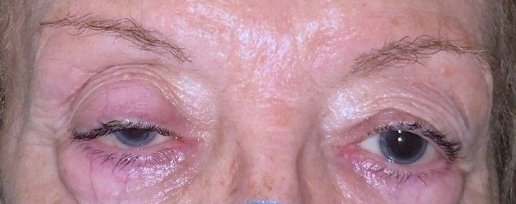 Ptosis Palpebral O Párpado Caído ¿qué Es Síntomas Y Tratamiento Icr 8466