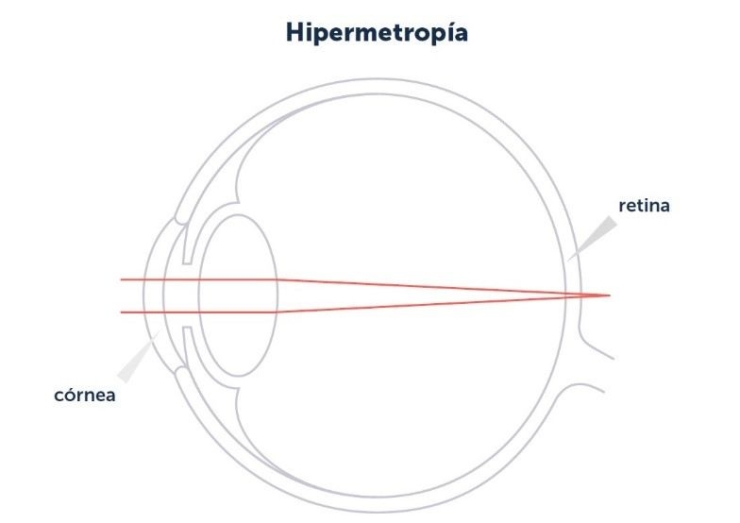 Hyperopia or Hypermetropia