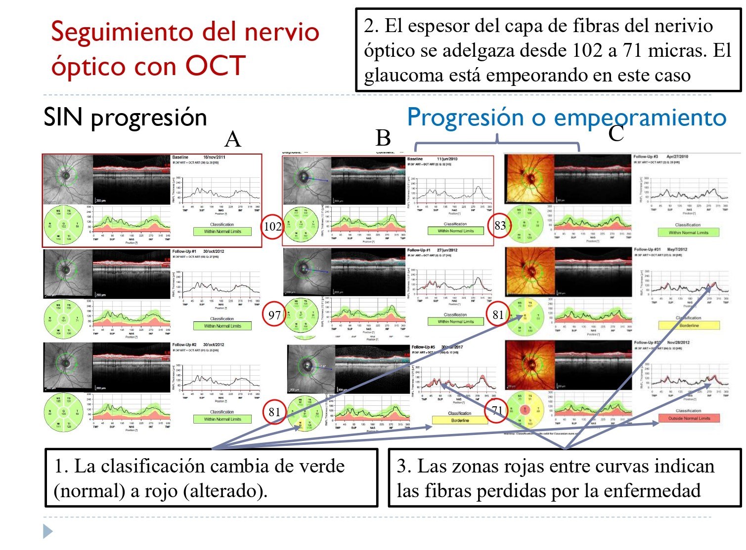 El doctor ha presentado diferentes imágenes obtenidas con OCT sobre la progresión del nervio óptico.