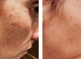 IPL therapy before and after