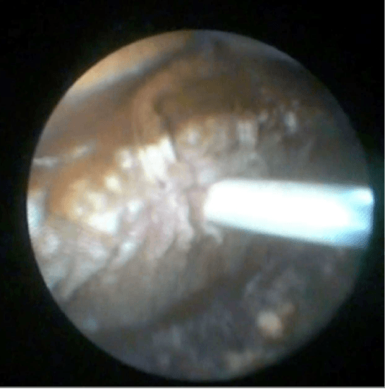 Imagen de mala posición de uno de los puntos de fijación de la lente Carlevale obtenida gracias al uso del endoscopio durante la cirugía.