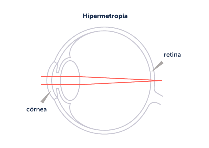 Ilustración explicativa de un ojo con hipermetropía