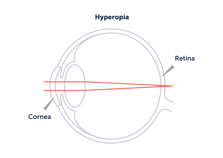 Illustration of an eye with hyperopia