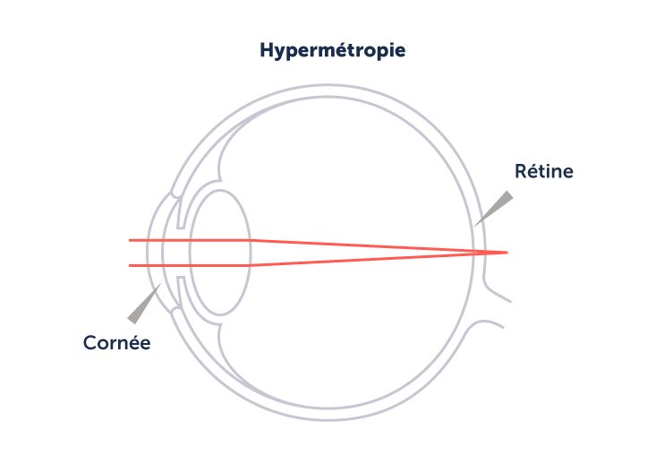 Illustration explicative d'un œil hypermétrope