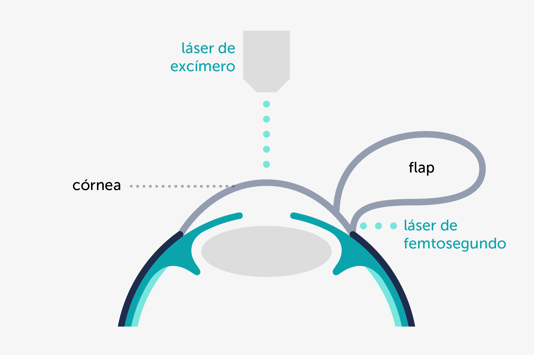 Ilustración que muestra de forma simplificada la técnica LASIK con láser de femtosegundo.