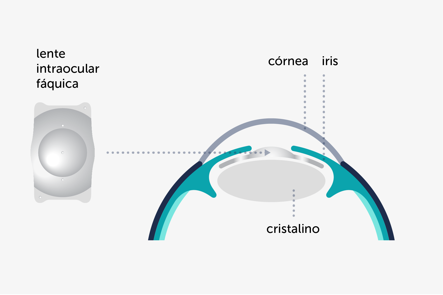 Ilustración que muestra de forma simplificada la implantación de la lente intraocular fáquica.