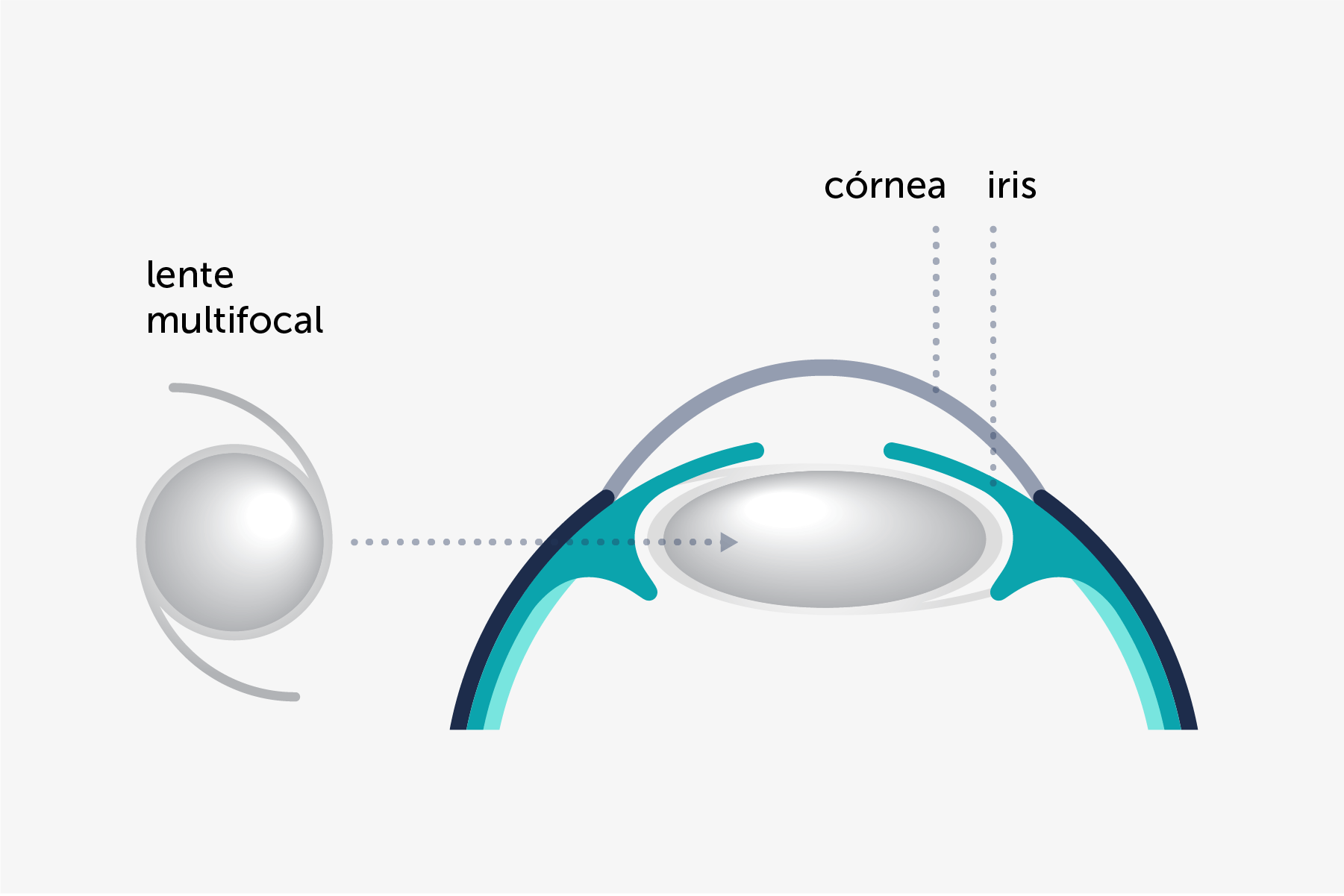 Ilustración que muestra de forma simplificada cómo es y dónde se implanta la lente multifocal.