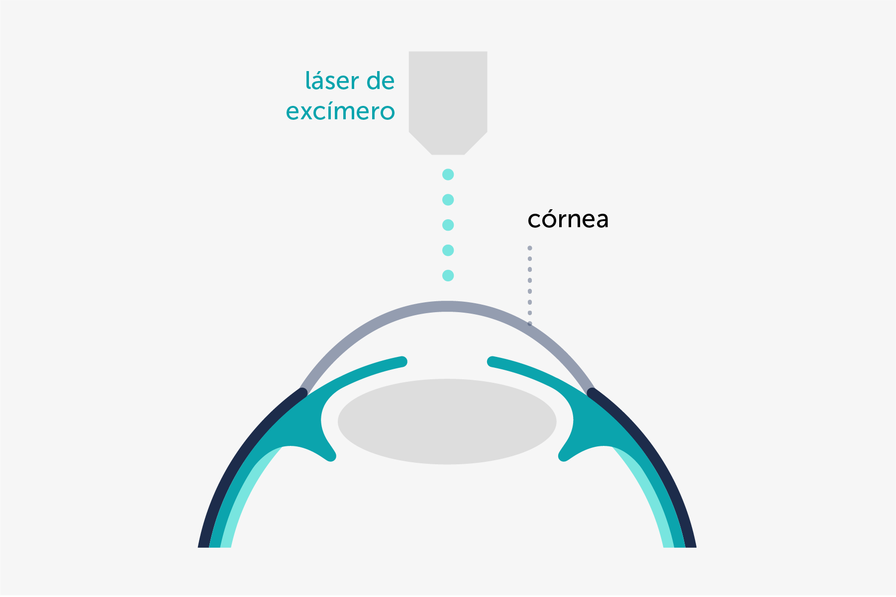 Ilustración que muestra de forma simplificada la técnica PRK y dónde actúa el láser de excímero.