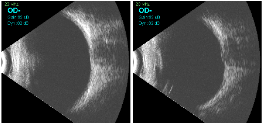 Part del resultat d’una ecografia ocular