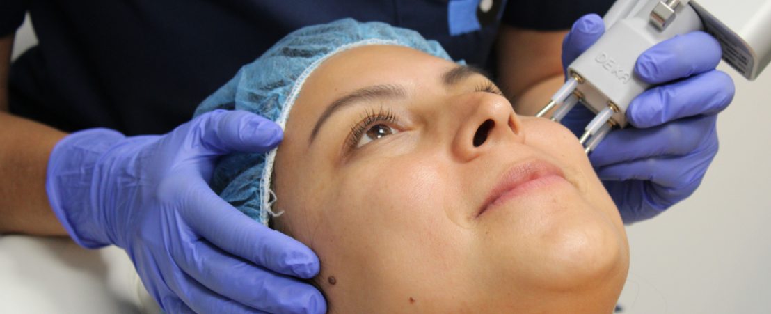 La Dra. Ibáñez aplica un tractament amb làser CO2 a una pacient a l'ICR. Pla detall.