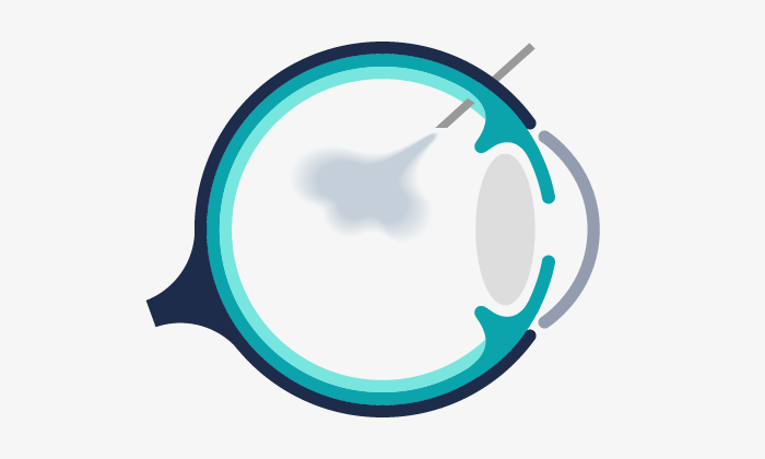 Ilustración esquemática del procedimiento de las inyecciones intravítreas en el ojo.