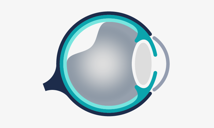 Illustration representing a vitreous detachment.