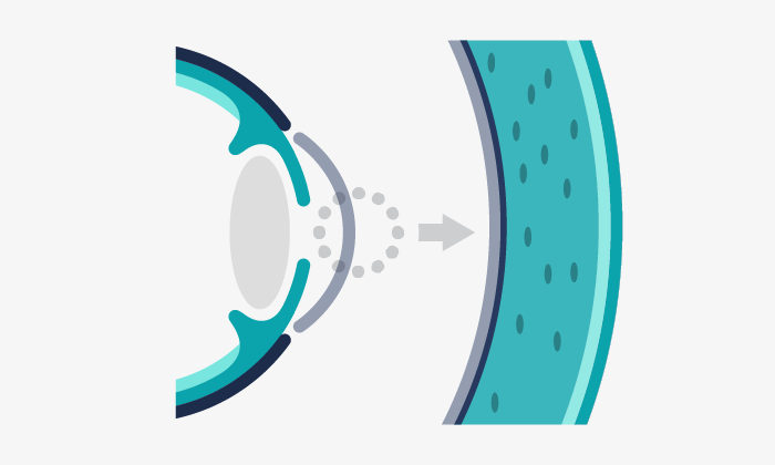 Illustration depicting corneal dystrophies.