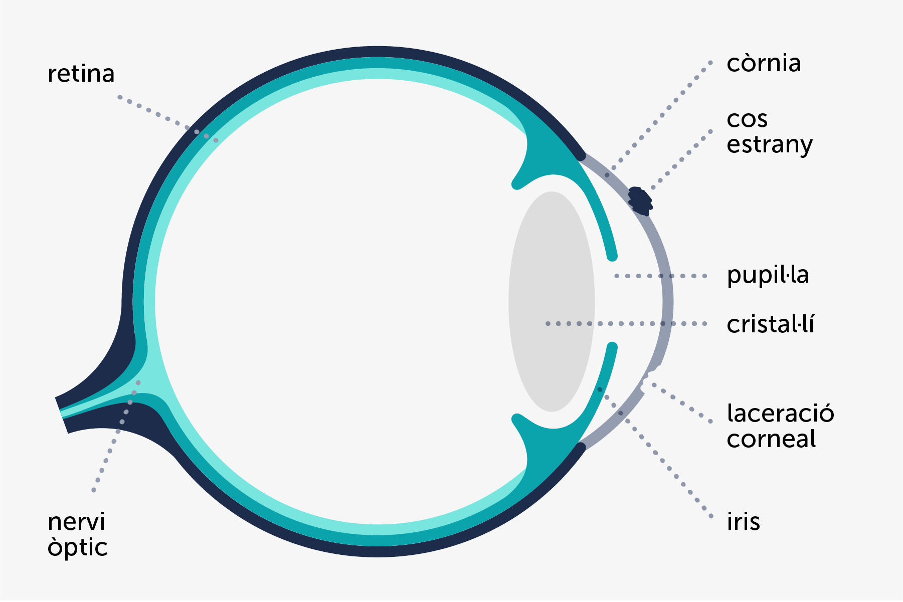 Infografia il·lustrada que mostra com (intervenció d'un cos estrany) i on (exterior de la còrnia) es produeixen algunes lesions corneals en un ull.