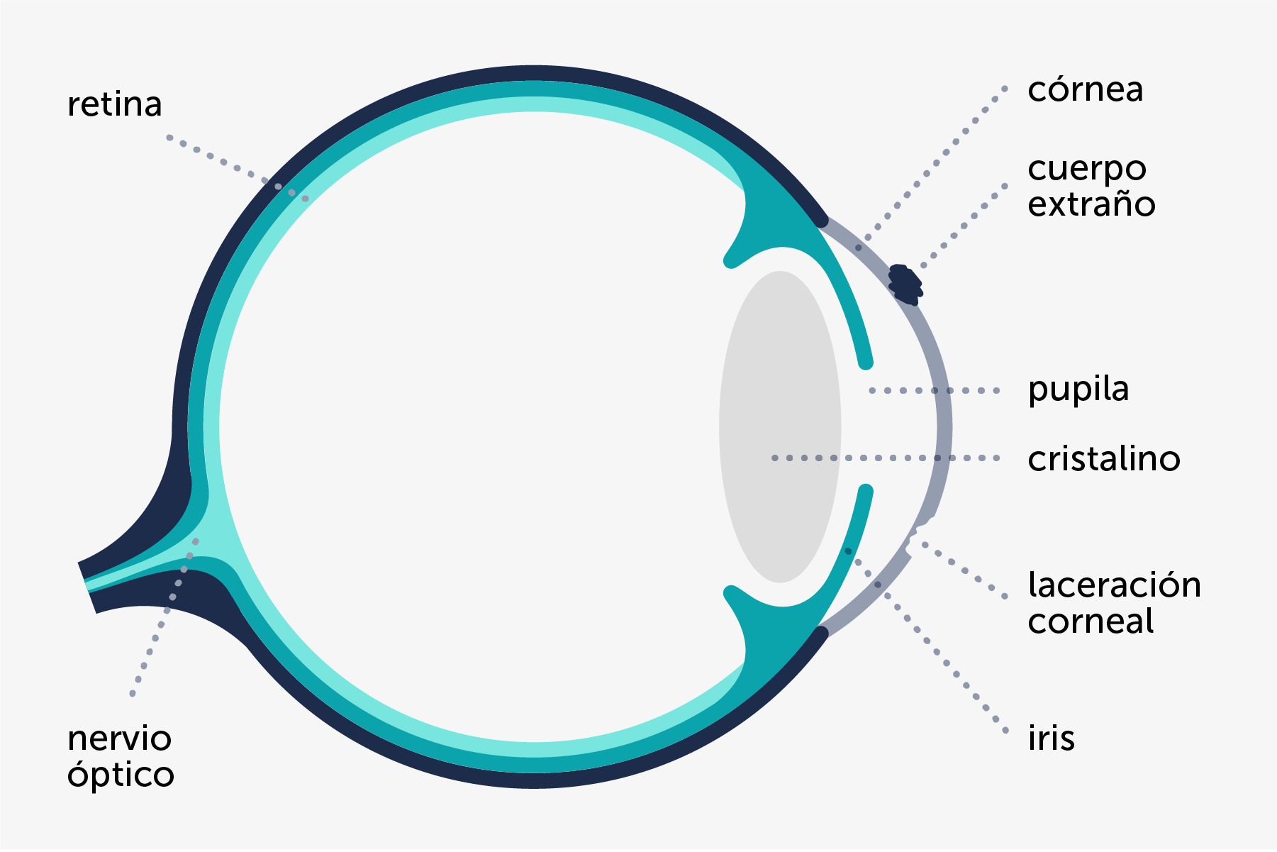 Infografía que muestra cómo y dónde se producen algunas lesiones corneales.